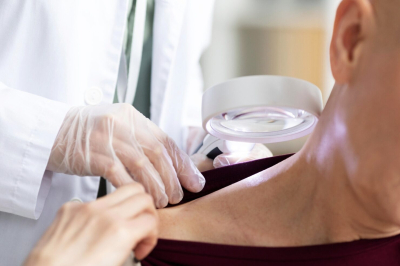 Дерматолог Линч назвал скрытые признаки меланомы